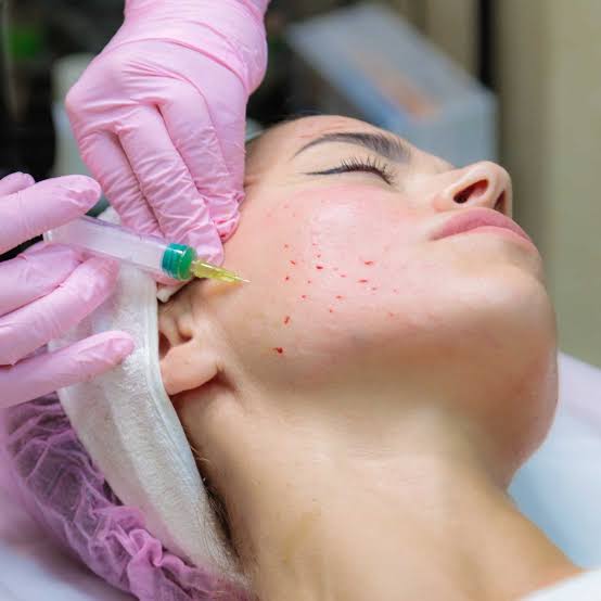 Close-up of a PRF facial treatment being delivered by a clinician in pink gloves